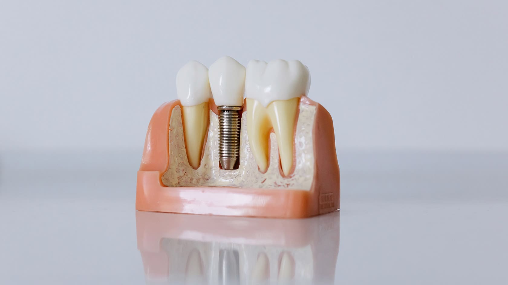 Diş implantı yaptırılmadan önce nelere dikkat edilmelidir?