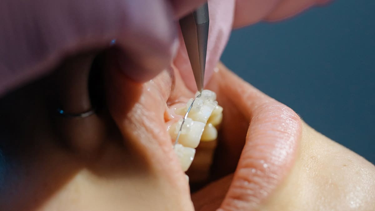 Diş telleri takıldıktan sonra bir süre rahatsızlık hissedilebilir.