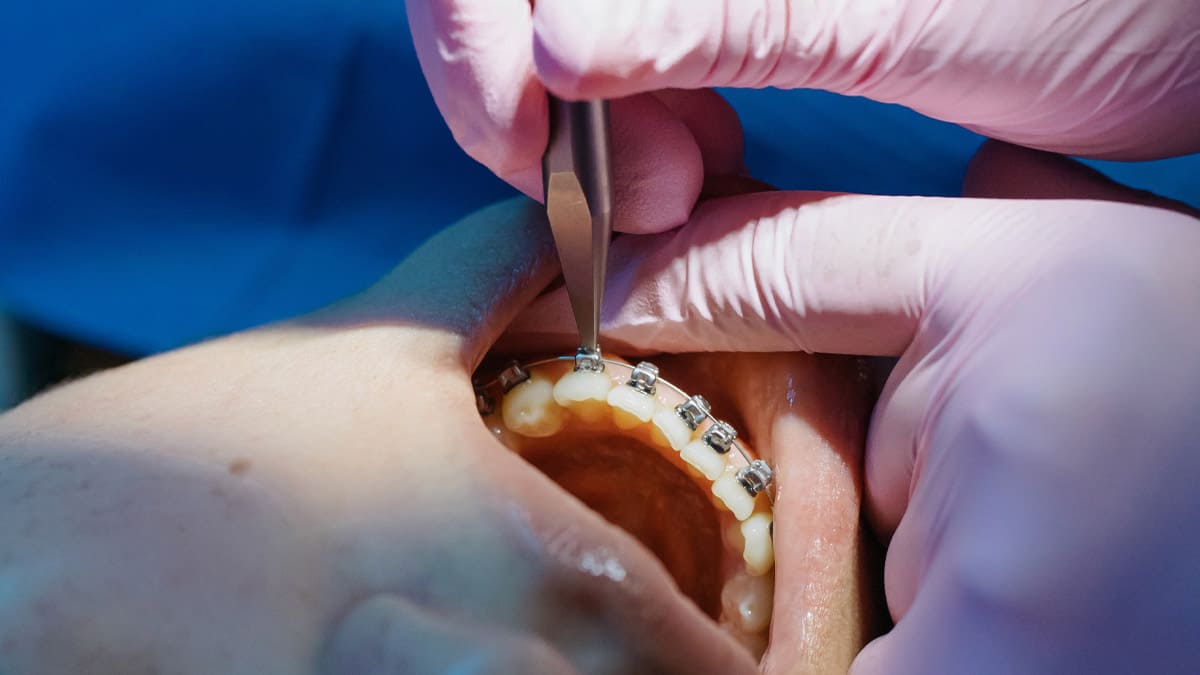 Diş teli tedavisinde nelere dikkat edilmeli?